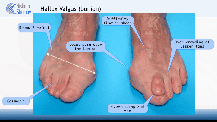 Hallux valgus, the ganglion on the big toe: Conservative treatment or  surgery?