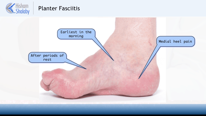 Top 7 Tips For Choosing Plantar Fasciitis Insoles | Heel Pain Relief —  Feet&Feet