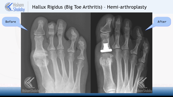 Great Toe Mtp Joint